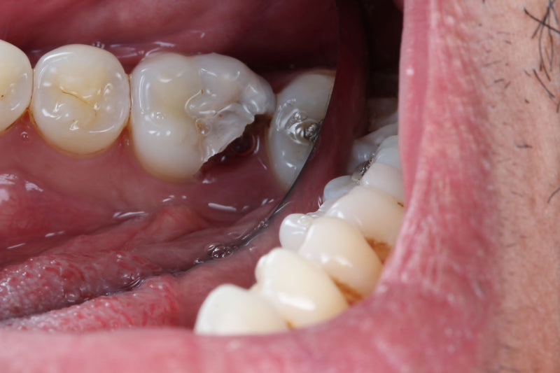 Webinar with Dr Debbie and Eva on saving compromised teeth